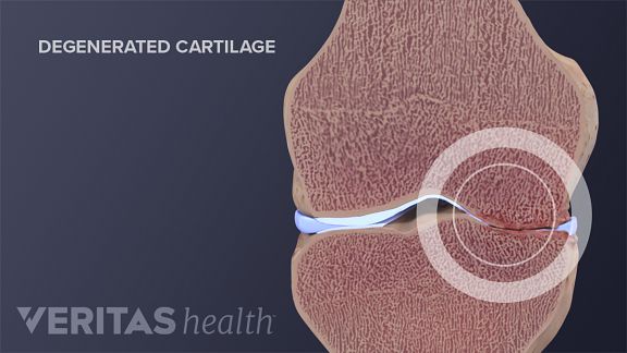 stem cell treatment for knee cartilage