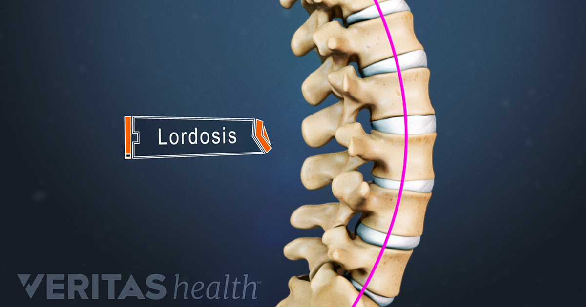 Lordosis Definition | Back Pain And Neck Pain Medical Glossary