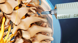 Cervical Epidural Injection going between the vertebrae.