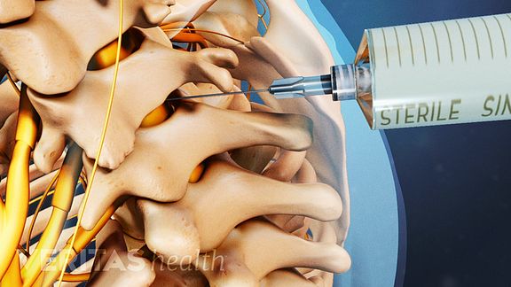 cervical-epidural-steroid-injections-can-bring-neck-and-arm-pain-relief