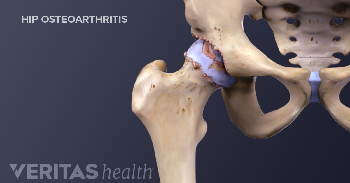 Osteoarthritis Complete Treatment Guide