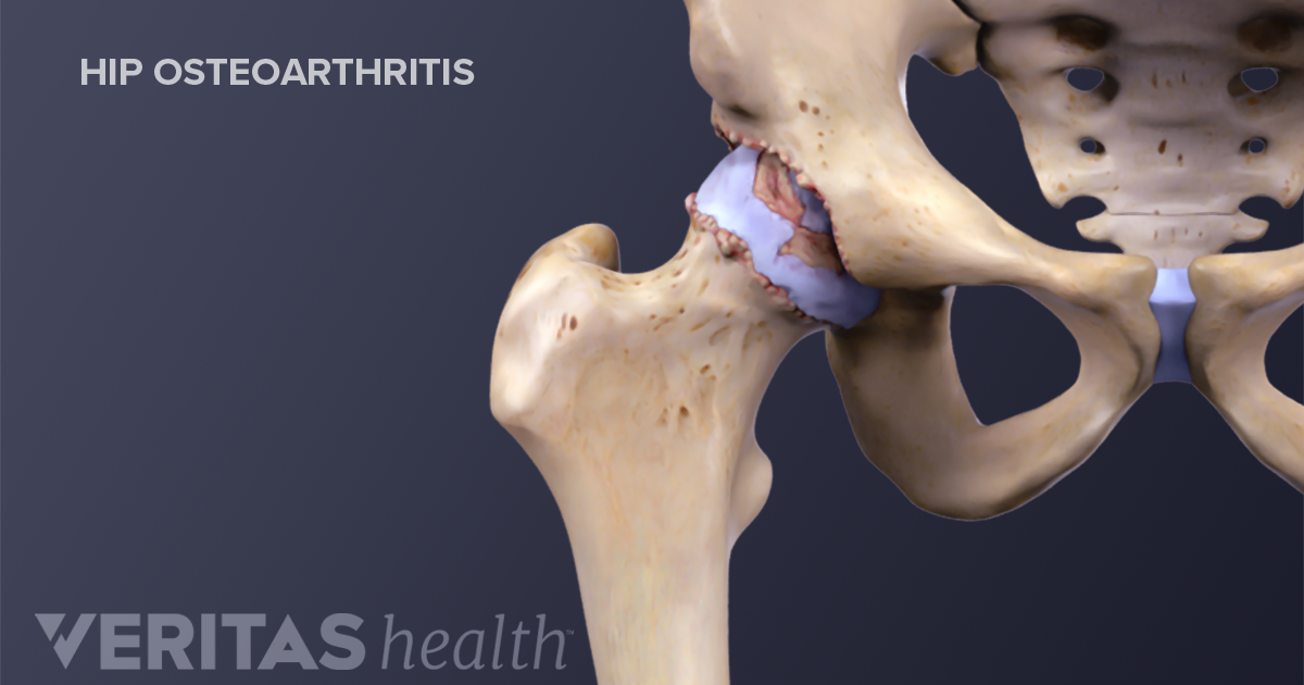 akutni tretman osteoartritisa artroza kuka 2 stupnja liječenja