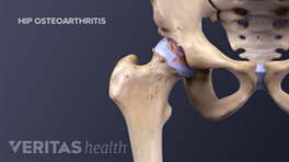 Facet Joint Osteoarthritis