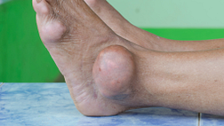 Gout attacks commonly strike in the middle of the night or early in the morning.