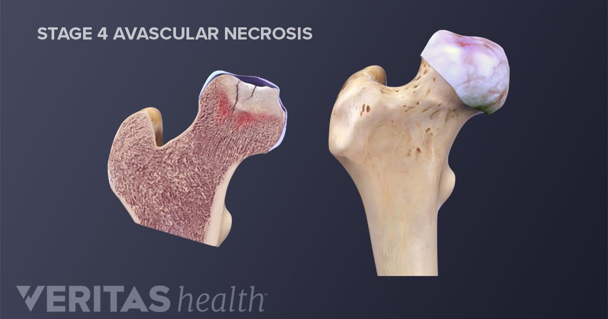 Avascular Necrosis Symptoms