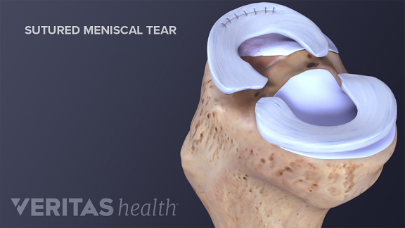 Meniscal Tear Treatment