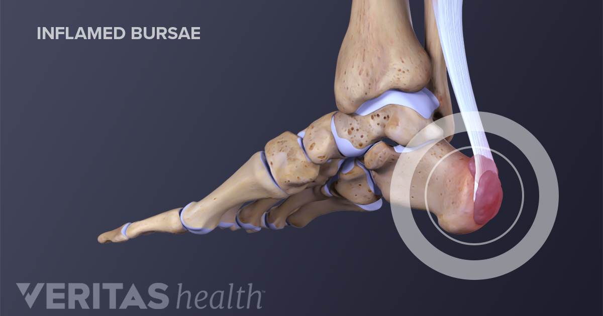 Heel Bursitis Treatment