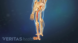 Medical illustration of the lower body, the sciatic nerve is highlighted in red to indicate pain, numbness or tingling.