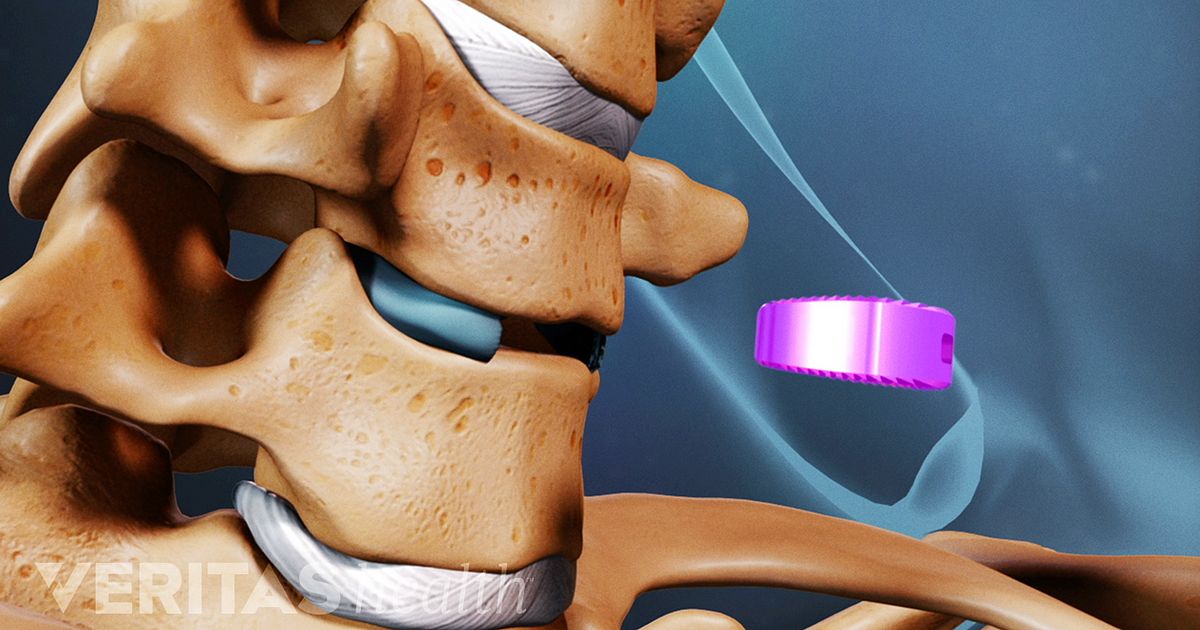 Anterior Cervical Decompression And Spine Fusion Procedure