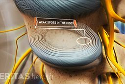 discogenic low back pain pdf