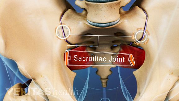 Understanding Piriformis Syndrome