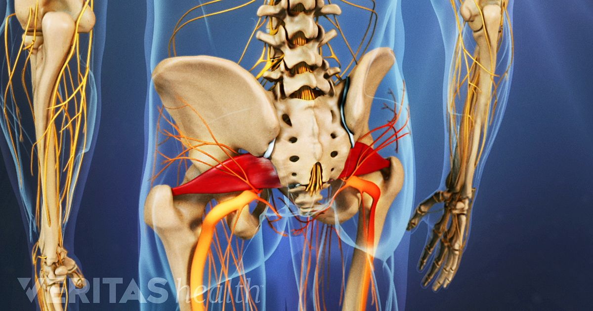 Piriformis Syndrome Video