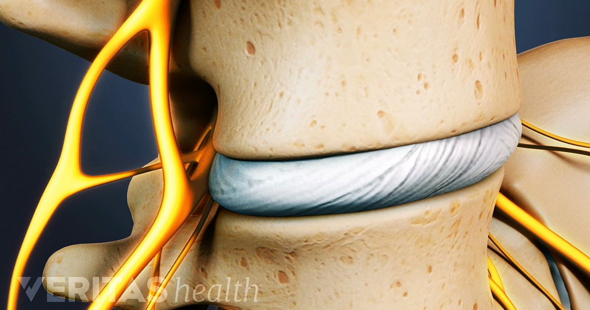 Anterior Lumbar Interbody Fusion (ALIF) Surgery