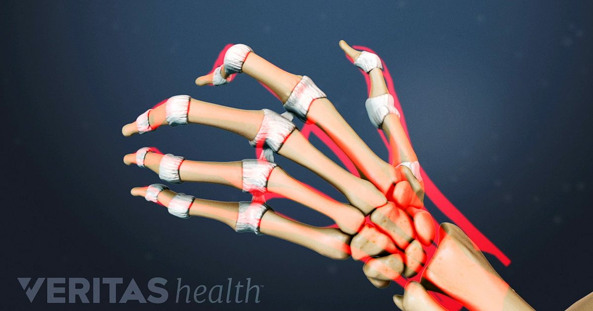 Hand Rheumatoid Arthritis Signs And Symptoms Hand Rheumatoid Arthritis Signs And Symptoms