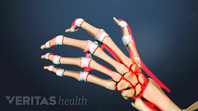 a csípő primer osteoarthritis fájdalom a középső ujj ízületében