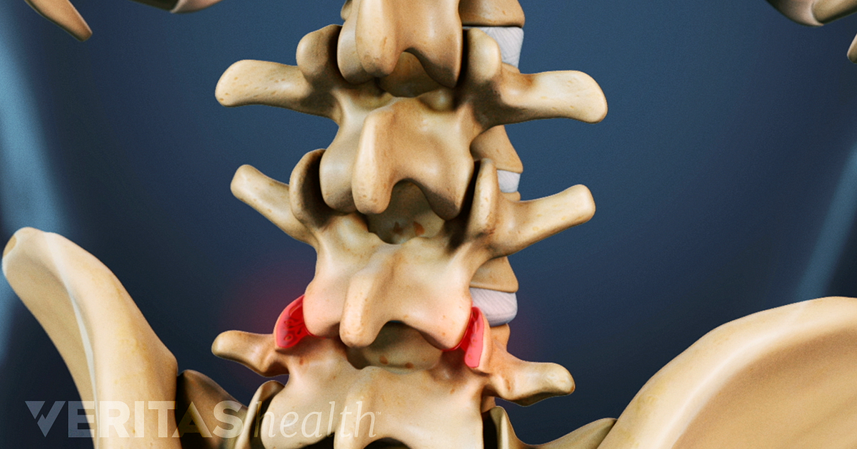 osteoartrita lombo-sacrala