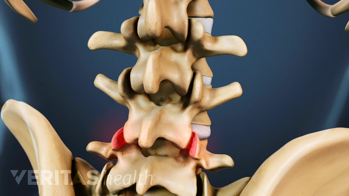 gerinc osteoarthritis mit kell tenni a nyaki gerinc osteochondrosisával