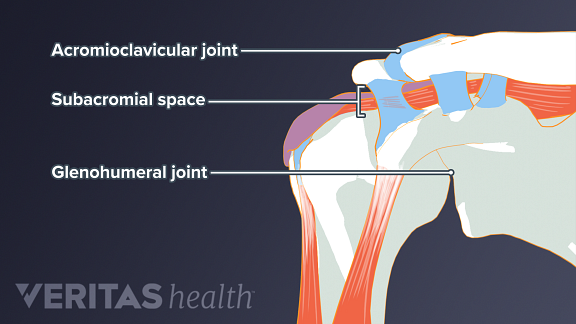 shoulder impingement