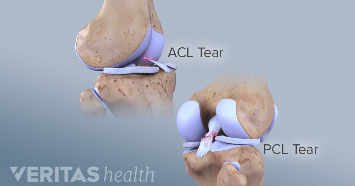 knee-ligament-tear-spring-loaded-tech