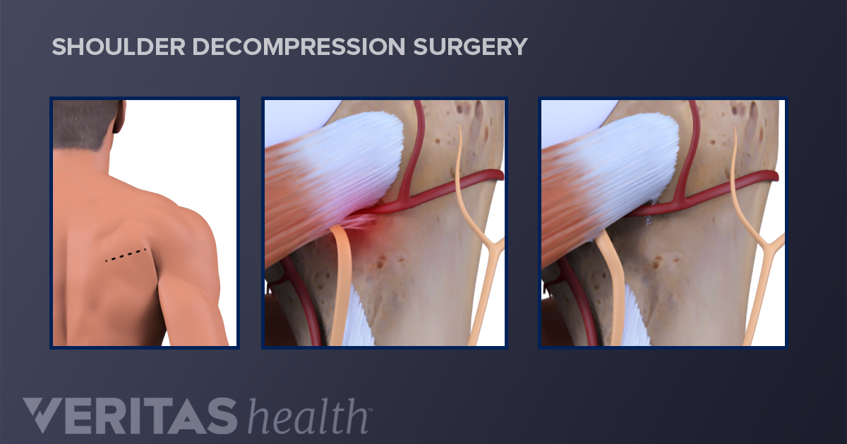 rotator cuff surgery recovery time