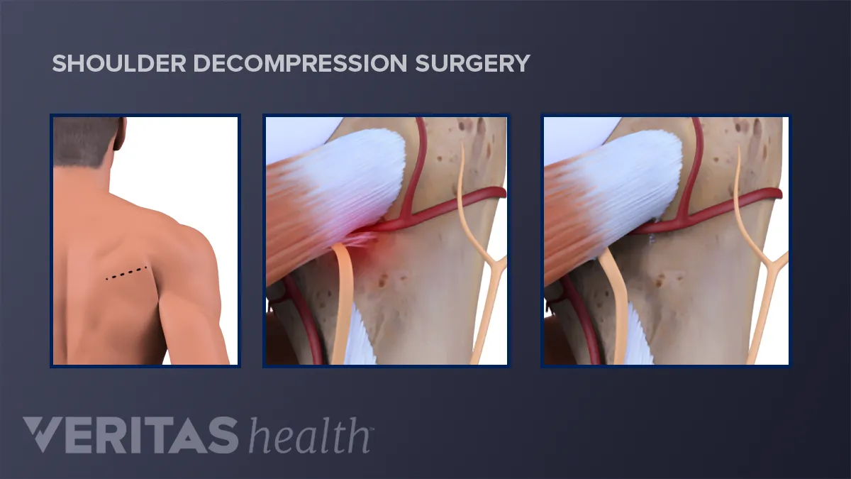 When Do Rotator Cuff Tears Fail After Surgical Repair?, Arthroscopic  Surgery