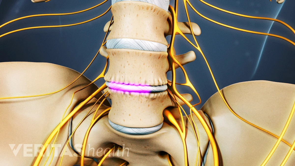 Potential Risks and Complications with ALIF Surgery Spine health