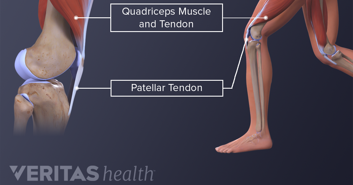 plantar tendonitis knee