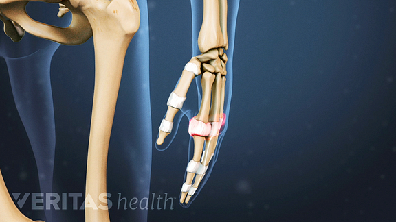 rheumatoid arthritis joint swelling
