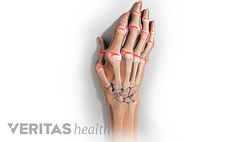Medical illustration of a deformed hand caused by arthritis