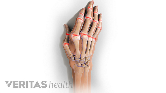 rheumatoid arthritis in the hand