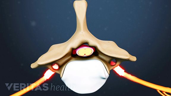 Cervical Spinal Stenosis