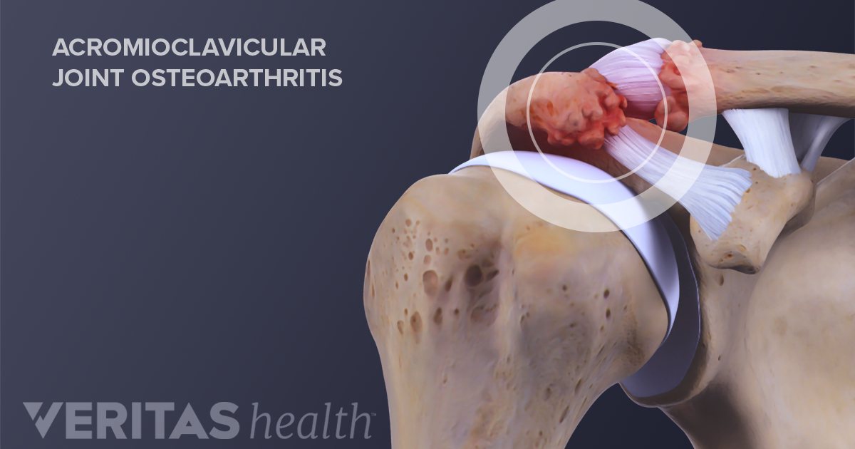 clavicularis arthrosis