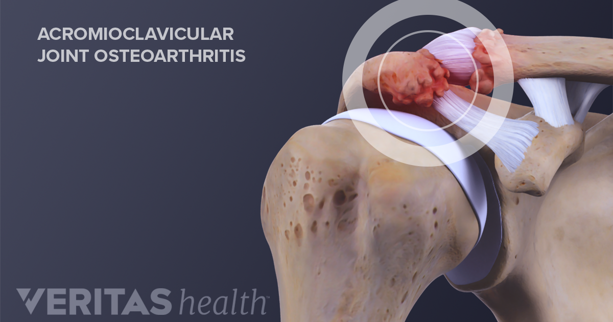 clavicularis acromialis arthrosis