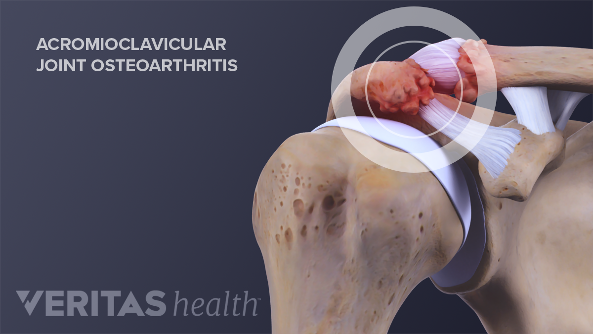 Clavicularis acromialis ízületi arthrosis, Tartós fájdalom az alsó hátán és az ízületekben