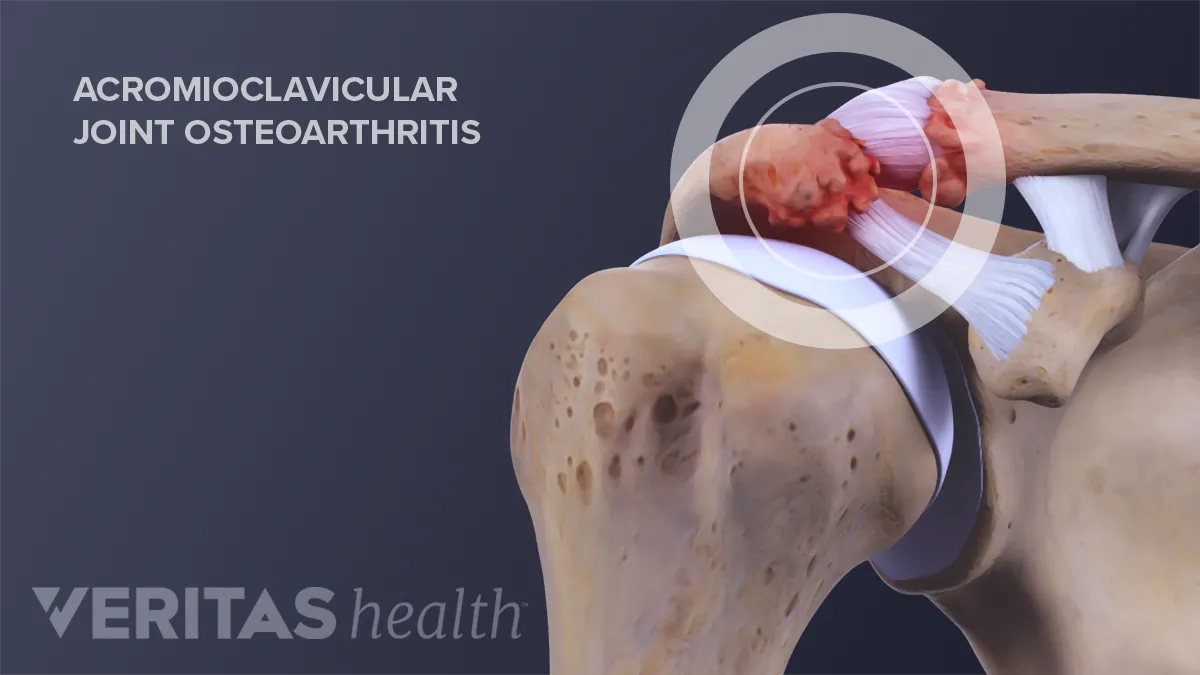 A clavicularis-acromialis ízület artrózisa 2 fok, A fájdalom tünetei és jellege patológiában