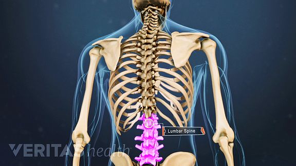 How a Vertebroplasty Procedure Eases Spinal Compression Fracture Pain