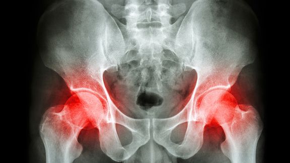 X-ray of the hips with hip joints highlighted in red