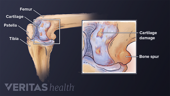 what arthritis in knee feels like