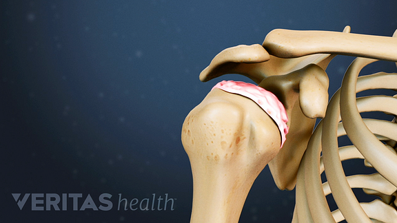 Medical illustration of the shoulder joint showing cartilage degeneration at the humeral head
