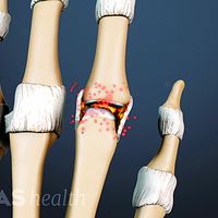 Palmar view of a hand with rheumatoid arthritis in the joints.