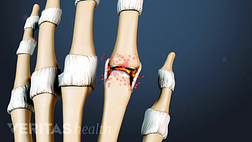 Medical illustration of the bones of the hand showing arthritis in the fingers