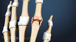Medical illustration of the bones of the hand showing arthritis in the fingers