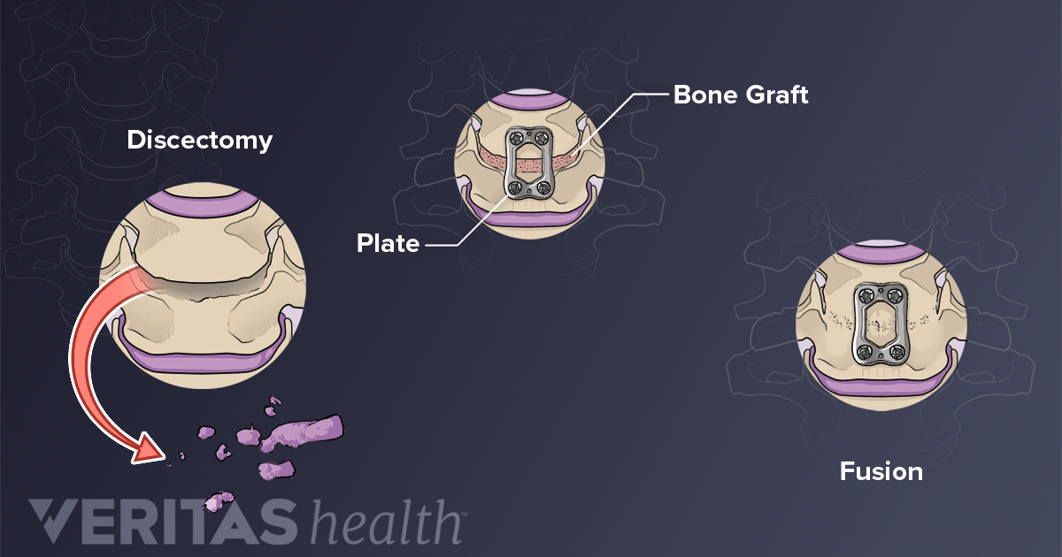 acdf-surgery-procedure