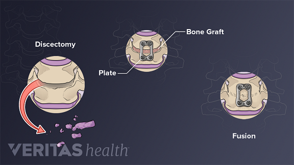 Controversies about Spinal Fusion Surgery: Allografts, Autografts, and Fusion Levels Controversies about Spinal Fusion Surgery: Allografts, Autografts, and Fusion Levels