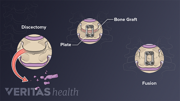 Illustration of the steps of an anterior cervical discectomy and fusion (ACDF) procedure