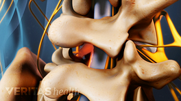 Posterior view of the cervical spine showing a microdiscectomy to relieve nerve pressure.