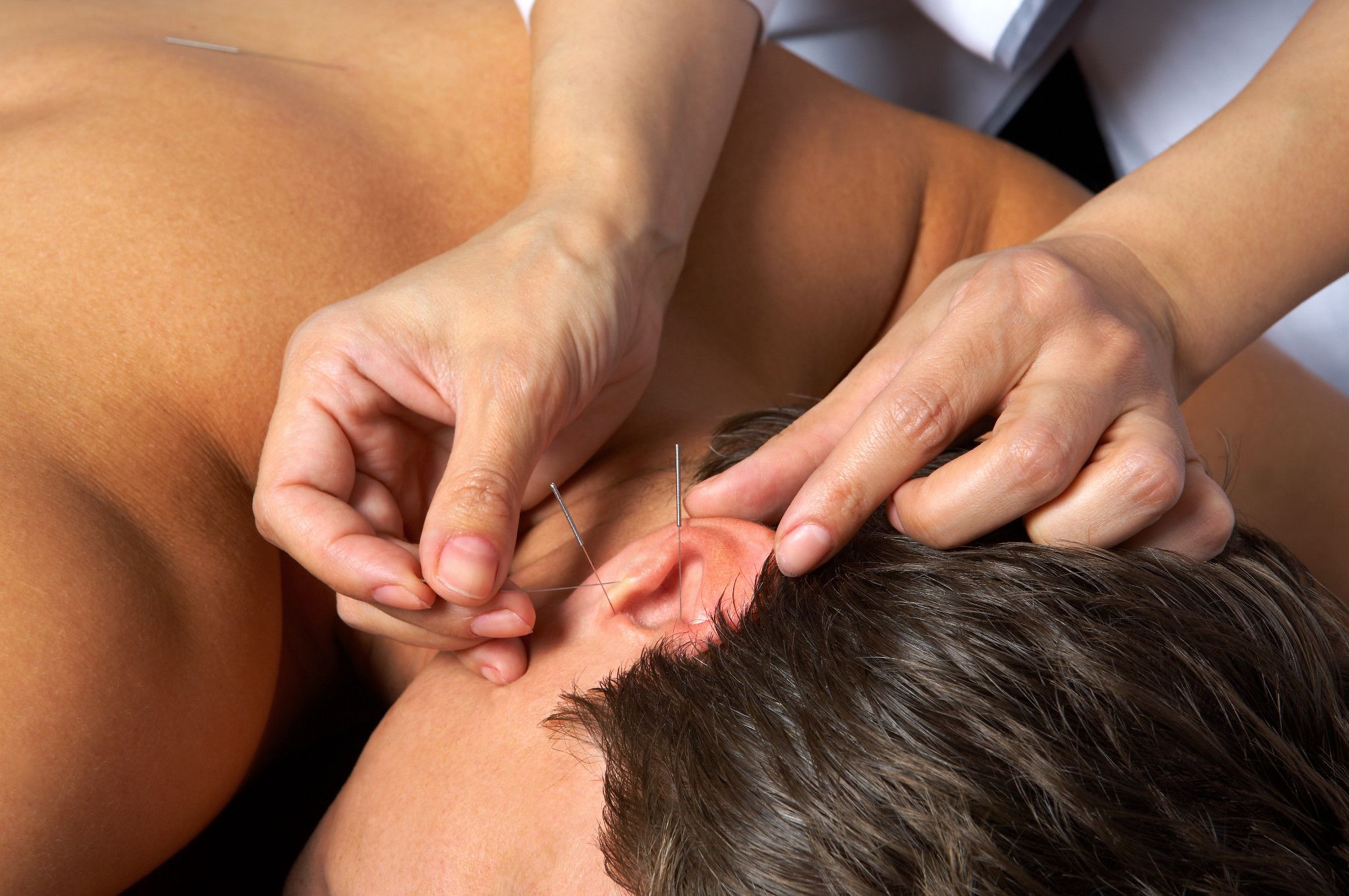 patient receiving acupuncture