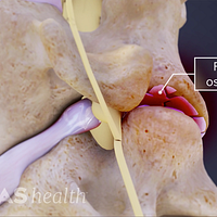 Profile view of two cervical vertebra showing facet joint osteoarthritis between the two vertebra.
