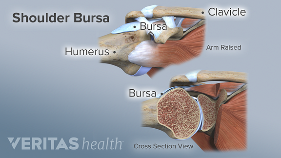 Celebrex for fever hip bursitis