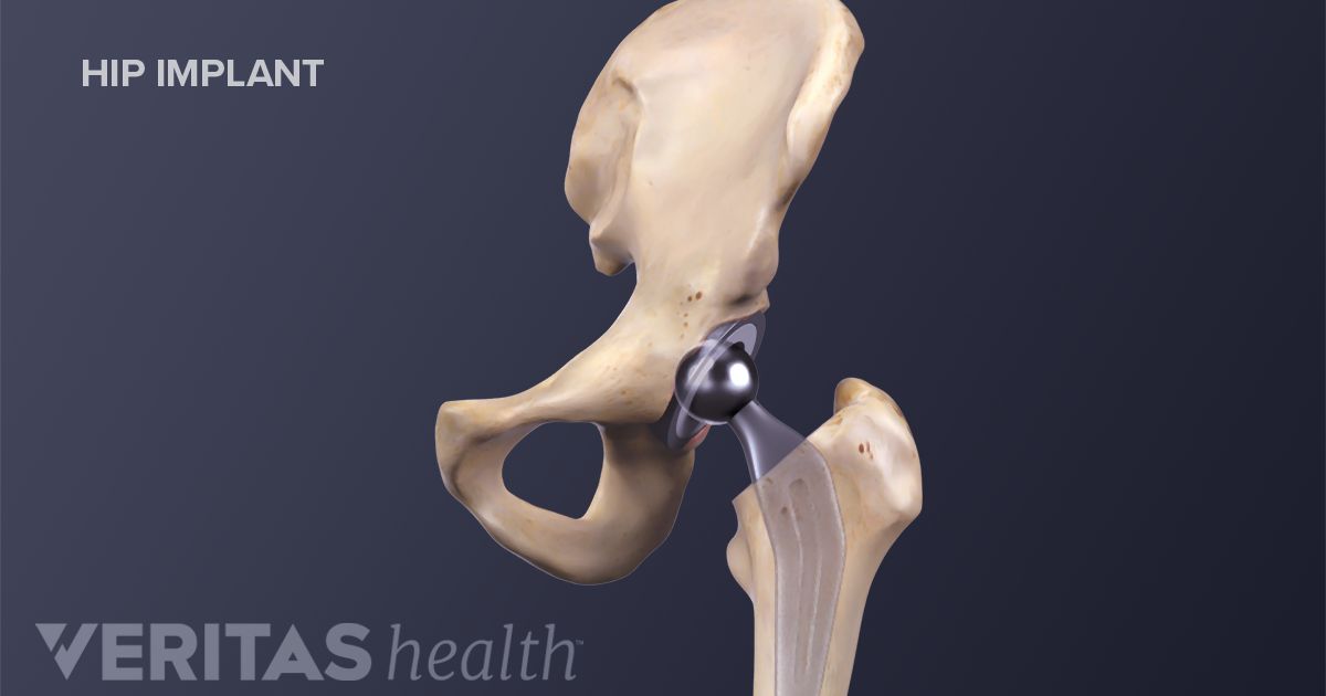 Total Hip Replacement Surgery Risks And Complications